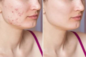 02- Learn How to Get Rid of Acne with Proven Skincare Tips